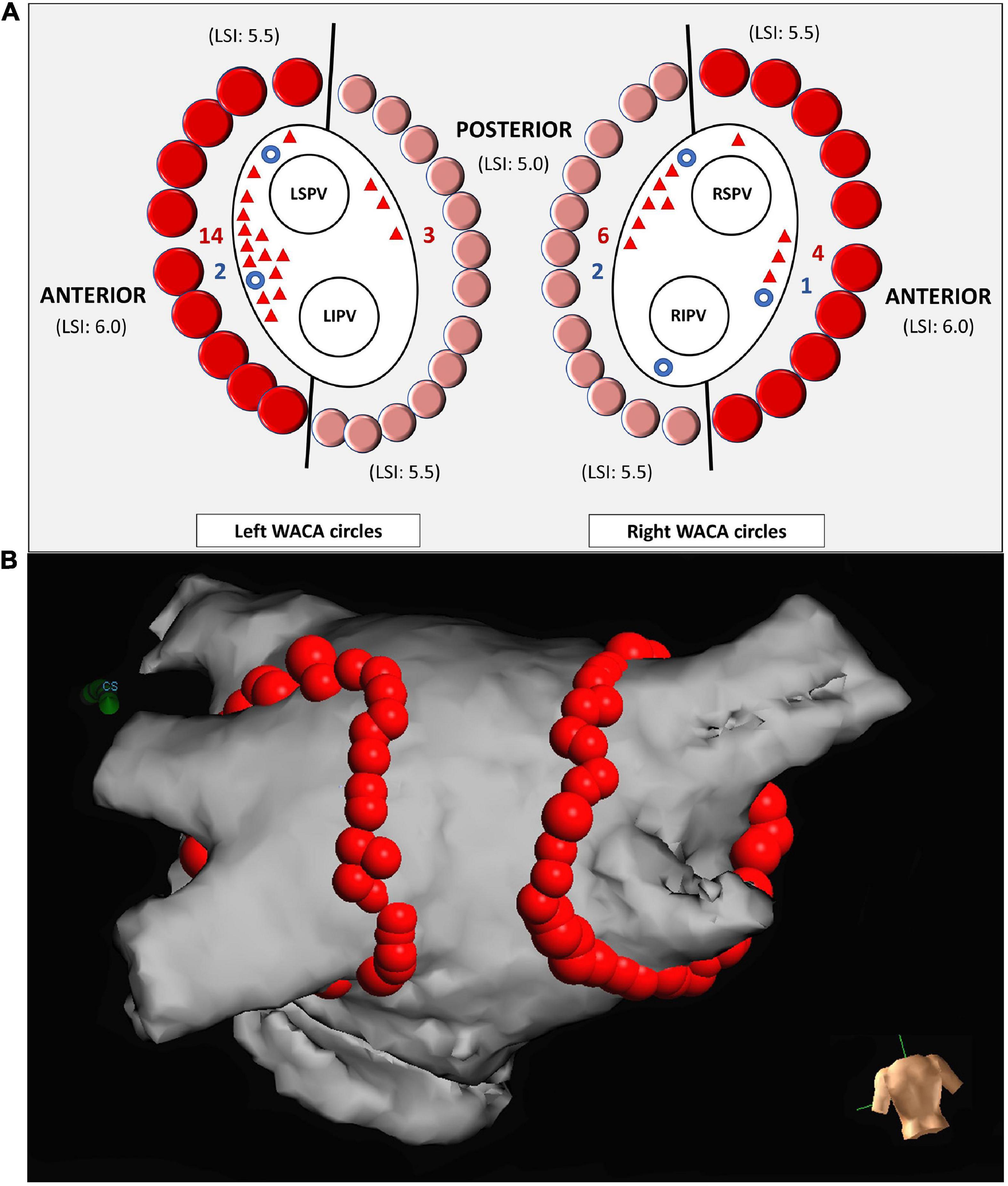 Risk factors for late reconnections after circumferential pulmonary vein isolation guided by lesion size index – Data from repeat invasive electrophysiology procedure